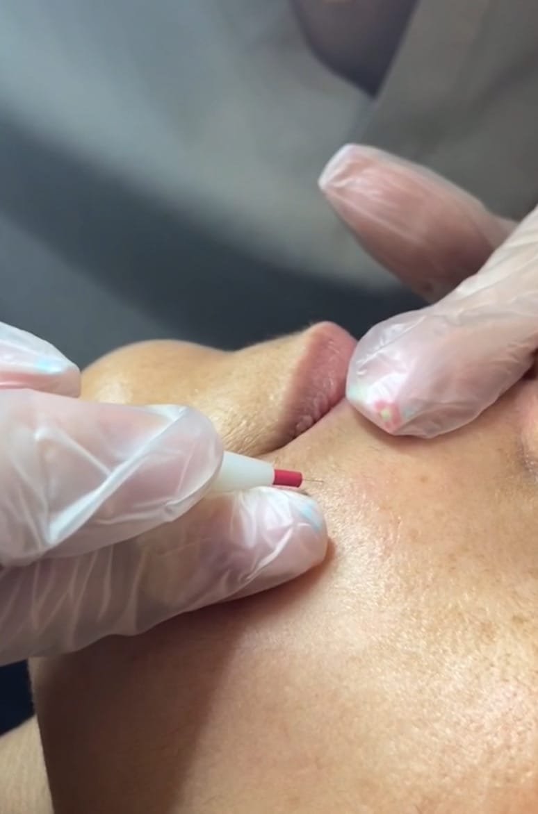 Épilation définitive par thermolyse à Paris avec Freed : efficace sur tous les types de poils